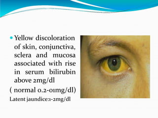  Yellow discoloration
of skin, conjunctiva,
sclera and mucosa
associated with rise
in serum bilirubin
above 2mg/dl
( normal 0.2-01mg/dl)
Latent jaundice:1-2mg/dl
 