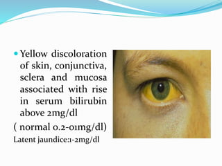  Yellow discoloration
of skin, conjunctiva,
sclera and mucosa
associated with rise
in serum bilirubin
above 2mg/dl
( norm...