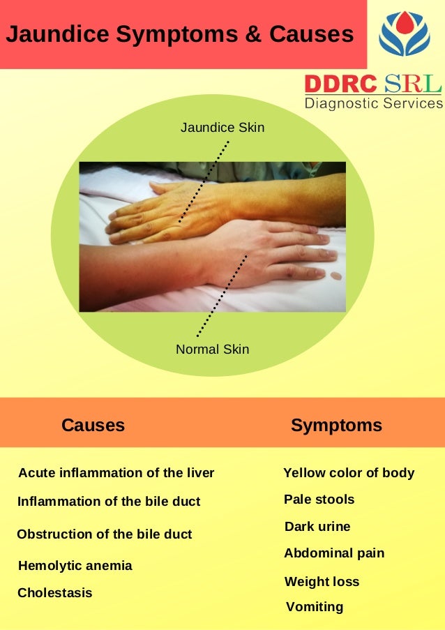 Jaundice Symptoms & Causes