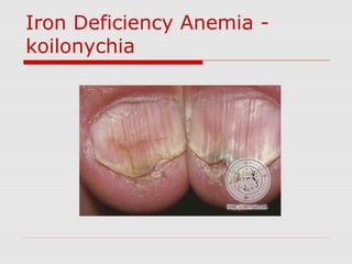 Iron Deficiency Anemia -
koilonychia
 