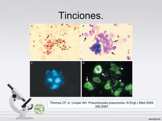 Tinciones.
Thomas CF Jr, Limper AH. Pneumocystis pneumonia. N Engl J Med 2004;
350:2487.
 