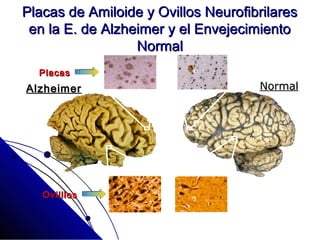 Placas de Amiloide y Ovillos Neurofibrilares
 en la E. de Alzheimer y el Envejecimiento
                  Normal
  Placas
Alzheimer                            Normal




   Ovilllos
 