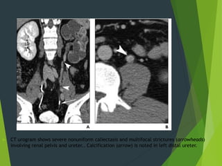 Male Genito-Urinary Tuberculosis | PPTX