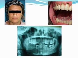 Jaw bone lesions