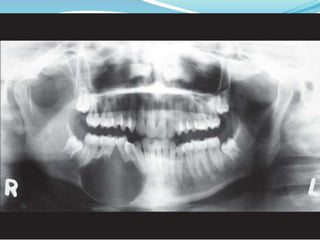 Jaw bone lesions