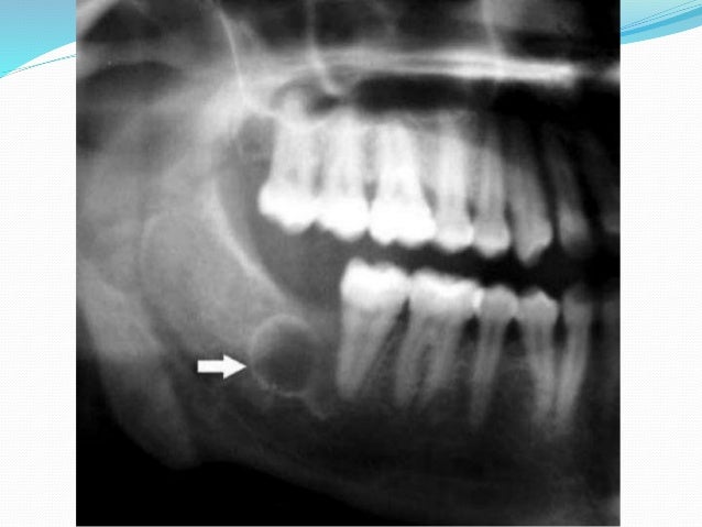 https://image.slidesharecdn.com/jawbonelesions-161201075751/95/jaw-bone-lesions-17-638.jpg?cb=1480579147