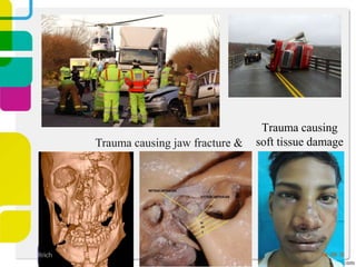 Trauma causing jaw fracture &

Trauma causing
soft tissue damage

 