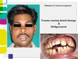 Malunion of fractured segments

Trauma causing dental damage
&
Disfigurement

 