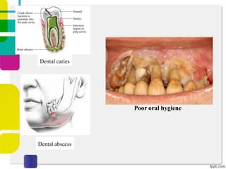Dental caries

Poor oral hygiene

Dental abscess

 