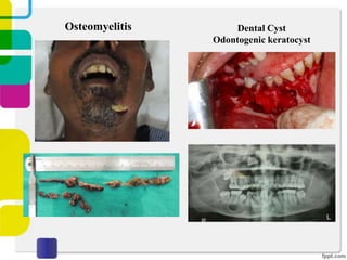 Osteomyelitis

Dental Cyst
Odontogenic keratocyst

 