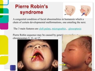 A congenital condition of facial abnormalities in humansin which a
chain of certain developmental malformations, one entailing the next.

The 3 main features are cleft palate, micrognathia , glossoptosis
Pierre Robin sequence may be caused by genetic anomalies at
chromosomes 2, 11, or 17.

 