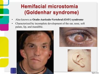 • Also known as Oculo-Auriculo-Vertebral (OAV) syndrome
• Characterized by incomplete development of the ear, nose, soft
palate, lip, and mandible.

 
