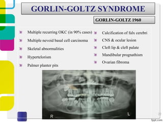 GORLIN-GOLTZ SYNDROME
GORLIN-GOLTZ 1960
Multiple recurring OKC (in 90% cases)

Calcification of falx cerebri

Multiple nevoid basal cell carcinoma

CNS & ocular lesion

Skeletal abnormalities

Cleft lip & cleft palate

Hypertelorism
Palmer planter pits

Mandibular prognathism
Ovarian fibroma

22

 