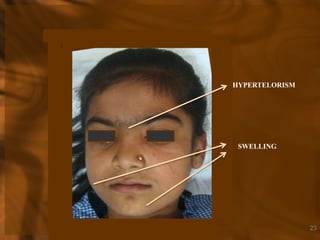 HYPERTELORISM

SWELLING

23

 