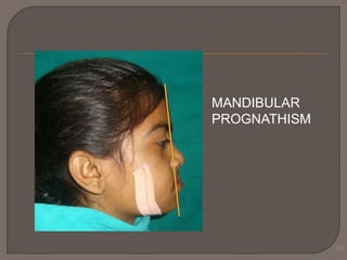 MANDIBULAR
PROGNATHISM

24

 
