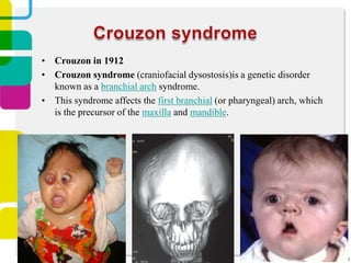 • Crouzon in 1912
• Crouzon syndrome (craniofacial dysostosis)is a genetic disorder
known as a branchial arch syndrome.
• This syndrome affects the first branchial (or pharyngeal) arch, which
is the precursor of the maxilla and mandible.

 