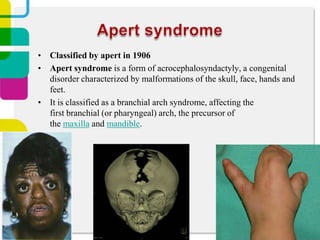• Classified by apert in 1906
• Apert syndrome is a form of acrocephalosyndactyly, a congenital
disorder characterized by malformations of the skull, face, hands and
feet.
• It is classified as a branchial arch syndrome, affecting the
first branchial (or pharyngeal) arch, the precursor of
the maxilla and mandible.

 