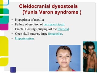 •
•
•
•
•

Hypoplasia of maxilla
Failure of eruption of permanent teeth.
Frontal Bossing (bulging) of the forehead.
Open skull sutures, large fontanelles.
Hypertelorism.

 