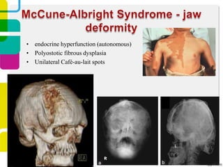 • endocrine hyperfunction (autonomous)
• Polyostotic fibrous dysplasia
• Unilateral Café-au-lait spots

 