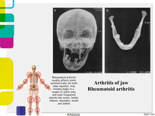 Arthritis of jaw
Rheumatoid arthritis

 