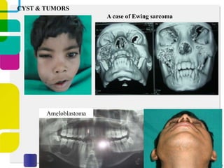 CYST & TUMORS
A case of Ewing sarcoma

Ameloblastoma

 