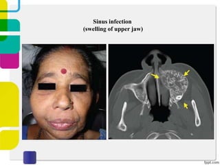 Sinus infection
(swelling of upper jaw)

 