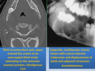 Well circumscribed cytic space
around the crown of an
unerrupted third molar
extending to the cemento-
enamel junction. Dentigerous
Cyst
Expansile, multilocular, lucent
lesion with coarse internal
trabeculae and displacement of
teeth and adjacent structures-
Ameloblastoma
 