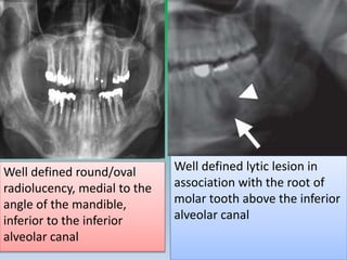 Well defined round/oval
radiolucency, medial to the
angle of the mandible,
inferior to the inferior
alveolar canal
Well defined lytic lesion in
association with the root of
molar tooth above the inferior
alveolar canal
 