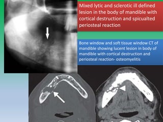 Mixed lytic and sclerotic ill defined
lesion in the body of mandible with
cortical destruction and spicualted
periosteal reaction
Bone window and soft tissue window CT of
mandible showing lucent lesion in body of
mandible with cortical destruction and
periosteal reaction- osteomyelitis
 