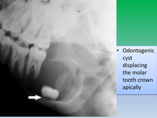 • Odontogenic
cyst
displacing
the molar
tooth crown
apically
 