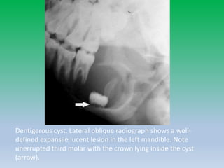 Dentigerous cyst. Lateral oblique radiograph shows a well-
defined expansile lucent lesion in the left mandible. Note
unerrupted third molar with the crown lying inside the cyst
(arrow).
 