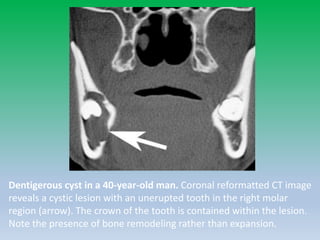 Dentigerous cyst in a 40-year-old man. Coronal reformatted CT image
reveals a cystic lesion with an unerupted tooth in the right molar
region (arrow). The crown of the tooth is contained within the lesion.
Note the presence of bone remodeling rather than expansion.
 