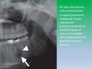 • 42-year-old woman
with periapicalcyst.
• Cropped panoramic
radiograph shows
radiolucent
lesion(arrowhead) in
posterior body of
ramus of mandible
with displacement of
mandibular canal
(arrow).
 