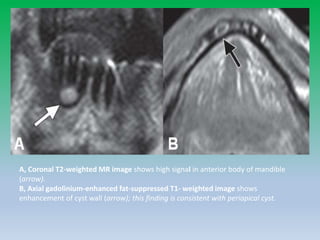 A, Coronal T2-weighted MR image shows high signal in anterior body of mandible
(arrow).
B, Axial gadolinium-enhanced fat-suppressed T1- weighted image shows
enhancement of cyst wall (arrow); this finding is consistent with periapical cyst.
 