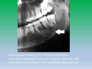 Odontogenic keratocyst in a 36-year-old woman.
Panoramic radiograph shows an ellipsoid, expansile, well-
corticated, lucent lesion in left mandibular body (arrow).
 