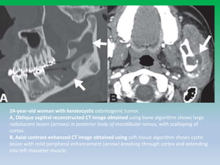 24-year-old woman with keratocystic odontogenic tumor.
A, Oblique sagittal reconstructed CT image obtained using bone algorithm shows large
radiolucent lesion (arrows) in posterior body of mandibular ramus, with scalloping of
cortex.
B, Axial contrast-enhanced CT image obtained using soft-tissue algorithm shows cystic
lesion with mild peripheral enhancement (arrow) breaking through cortex and extending
into left masseter muscle.
 