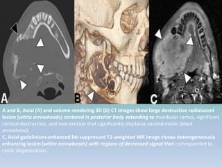A and B, Axial (A) and volume-rendering 3D (B) CT images show large destructive radiolucent
lesion (white arrowheads) centered in posterior body extending to manibular ramus, significant
cortical destruction, and root erosion that significantly displaces second molar (black
arrowhead).
C, Axial gadolinium-enhanced fat-suppressed T1-weighted MR image shows heterogeneously
enhancing lesion (white arrowheads) with regions of decreased signal that corresponded to
cystic degeneration.
 