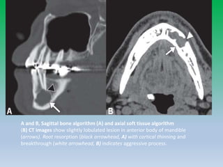 A and B, Sagittal bone algorithm (A) and axial soft tissue algorithm
(B) CT images show slightly lobulated lesion in anterior body of mandible
(arrows). Root resorption (black arrowhead, A) with cortical thinning and
breakthrough (white arrowhead, B) indicates aggressive process.
 