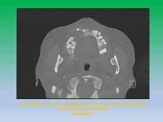 Odontogenic myxoma: Bubbly lytic lesion in the rt side of maxilla
with multiple thin internal
septations
 