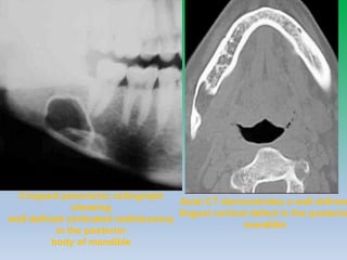 Cropped panoramic radiograph
showing
well defined corticated radiolucency
in the posterior
body of mandible
Axial CT demonstrates a well defined
lingual cortical defect in the posterio
mandible
 