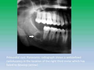 Primordial cyst. Panoramic radiograph shows a welldefined
radiolucency in the location of the right third molar which has
failed to develop (arrow).
 