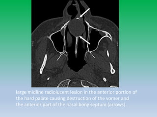 large midline radiolucent lesion in the anterior portion of
the hard palate causing destruction of the vomer and
the anterior part of the nasal bony septum (arrows).
 