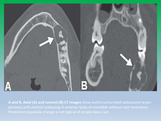 A and B, Axial (A) and coronal (B) CT images show wellcircumscribed radiolucent lesion
(arrows) with cortical scalloping in anterior body of mandible without root resorption.
Prominent expansile change is not typical of simple bone cyst.
 