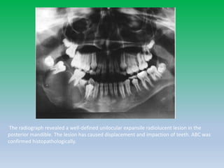 The radiograph revealed a well-defined unilocular expansile radiolucent lesion in the
posterior mandible. The lesion has caused displacement and impaction of teeth. ABC was
confirmed histopathologically.
 