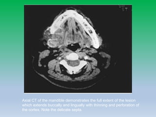 Axial CT of the mandible demonstrates the full extent of the lesion
which extends buccally and lingually with thinning and perforation of
the cortex. Note the delicate septa.
 