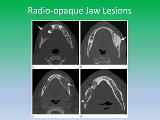 Radio-opaque Jaw Lesions
 