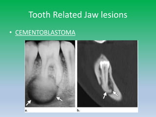 Tooth Related Jaw lesions
• CEMENTOBLASTOMA
 