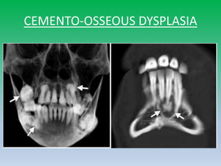 CEMENTO-OSSEOUS DYSPLASIA
 
