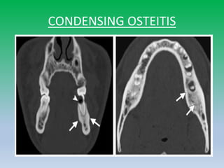 CONDENSING OSTEITIS
 