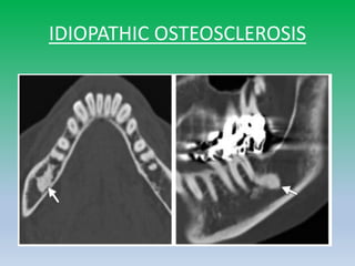 IDIOPATHIC OSTEOSCLEROSIS
 